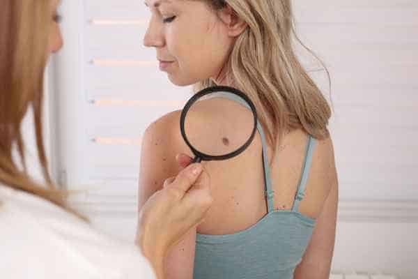 What Are Traditional Skin Lesion Removal Methods Ilford?