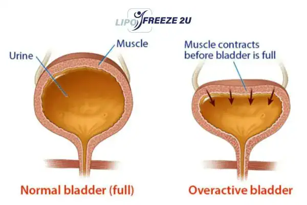 diagram of overactive bladder treatment Ilford