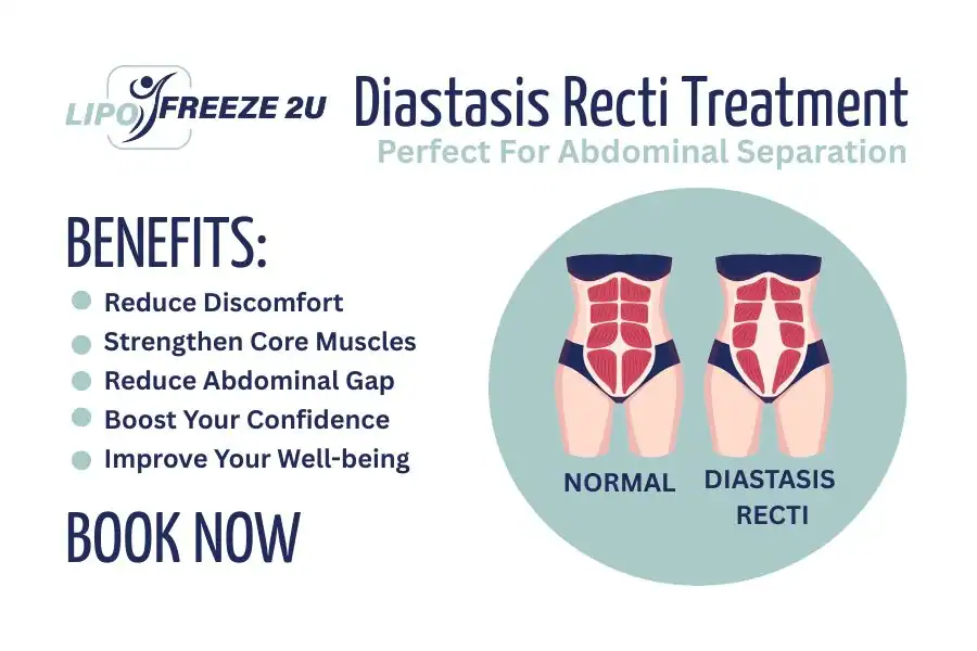 Benefits of body toning treatment Ilford for Diastasis recti