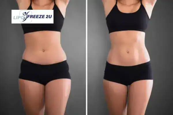 How Can LIPO FREEZE 2U Support Your Post-Pregnancy Body Recovery Ilford?