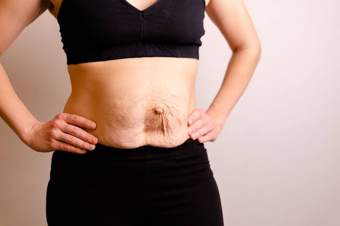 Is Surgery Really the Only Way to Repair Diastasis Recti Ilford?