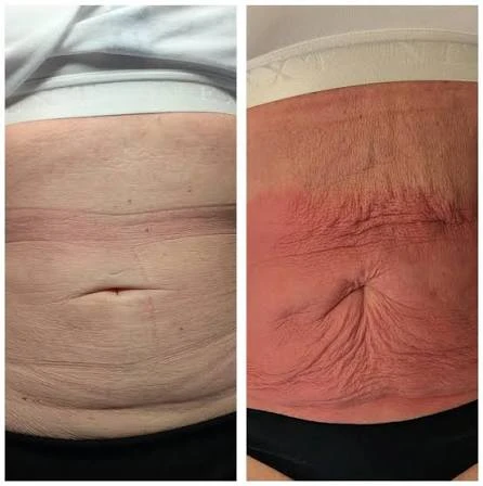 How Does RF Microneedling Improve Crepey, Thin and Uneven Skin Texture Ilford?