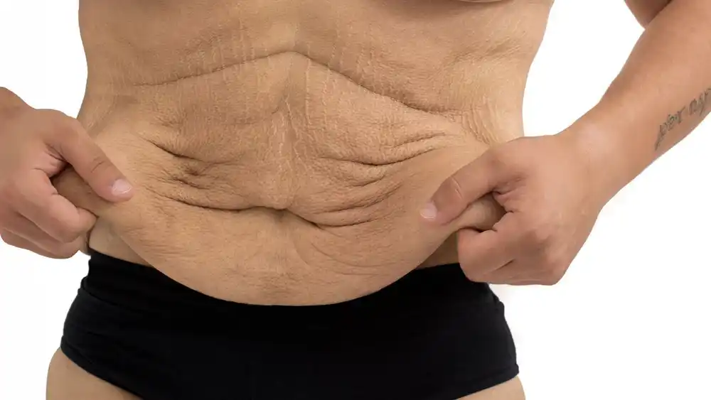 RF Microneedling for Loose Skin: How Can It Help Tighten and Reshape the Skin Ilford?
